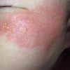 Step 2 - 滋潤修復濕疹霜(母嬰配方)Eczema Therapy Botanical Cream (Mother & Baby Formula)50m/100ml