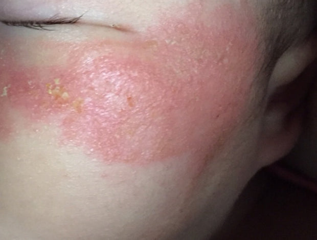 Step 2 - 滋潤修復濕疹霜（母嬰配方）Eczema Therapy Botanical Cream （Mother & Baby Formula）50m/100ml