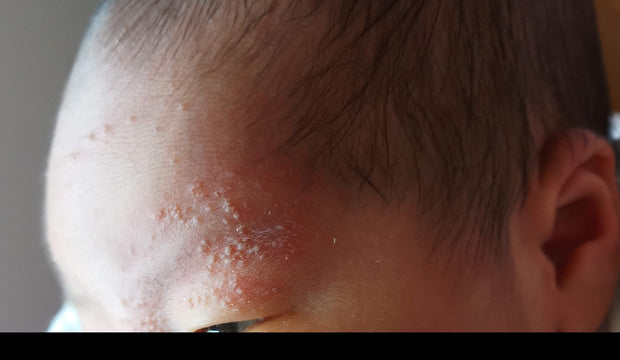 Step 2 - 滋潤修復濕疹霜（母嬰配方）Eczema Therapy Botanical Cream （Mother & Baby Formula）50m/100ml